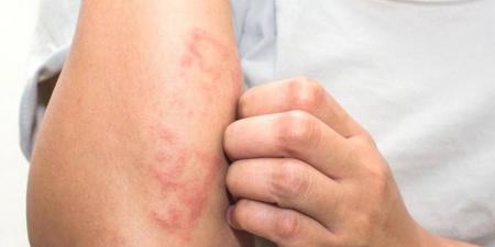 بالبلدي : علاج الأكزيما بزيت الزيتون